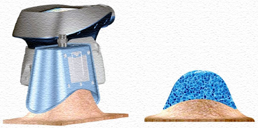CRIOLIPOLISIS