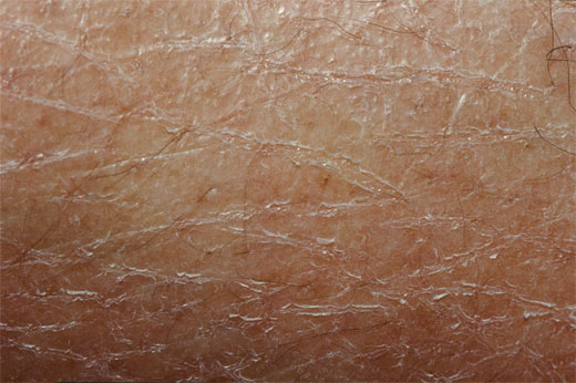 Xerosis