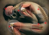 Sndrome de Dolor Miofascial y puntos gatillo El Sndrome de Dolor Miofascial