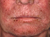 Xerosis cutnea