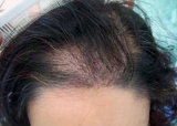 Alopeca telgena