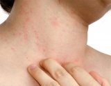 La psoriasis y el sistema inmunolgico
