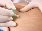 Carboxiterapia e celulite